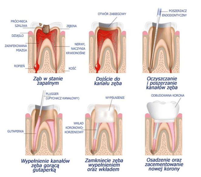 Leczenie Kanałowe Bełchatów Endodoncja Pod Mikroskopem 0516